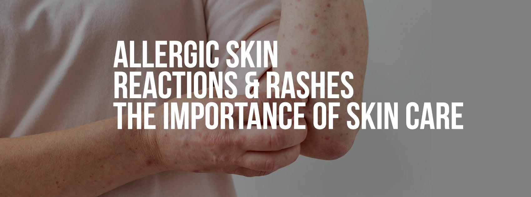 Allergic Skin Reactions & Rashes – The importance of Skin Care