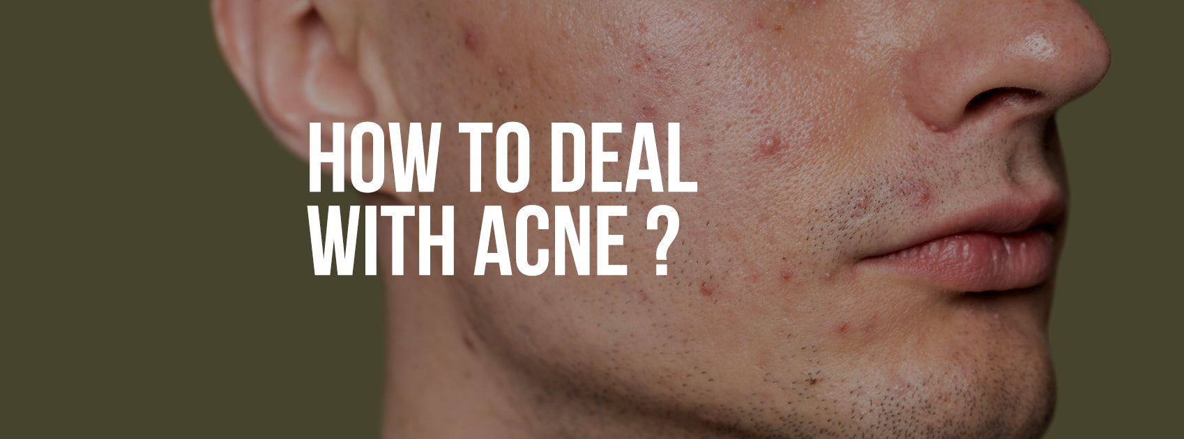 HOW TO DEAL WITH ACNE? SYMPTOMS, TRIGGERS & REMEDY