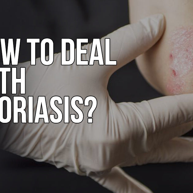 HOW TO DEAL WITH PSORIASIS & NATURAL REMEDIES FOR IT