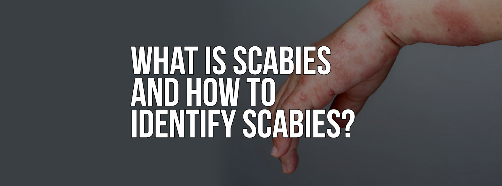 What is Scabies and How to Identify Scabies?