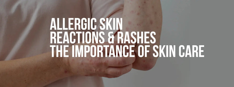 Allergic Skin Reactions & Rashes – The importance of Skin