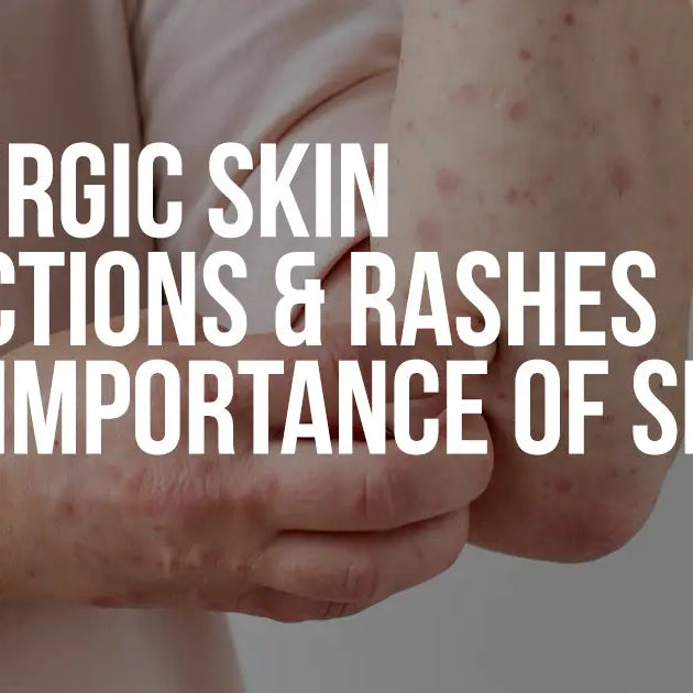 Allergic Skin Reactions & Rashes – The importance of Skin