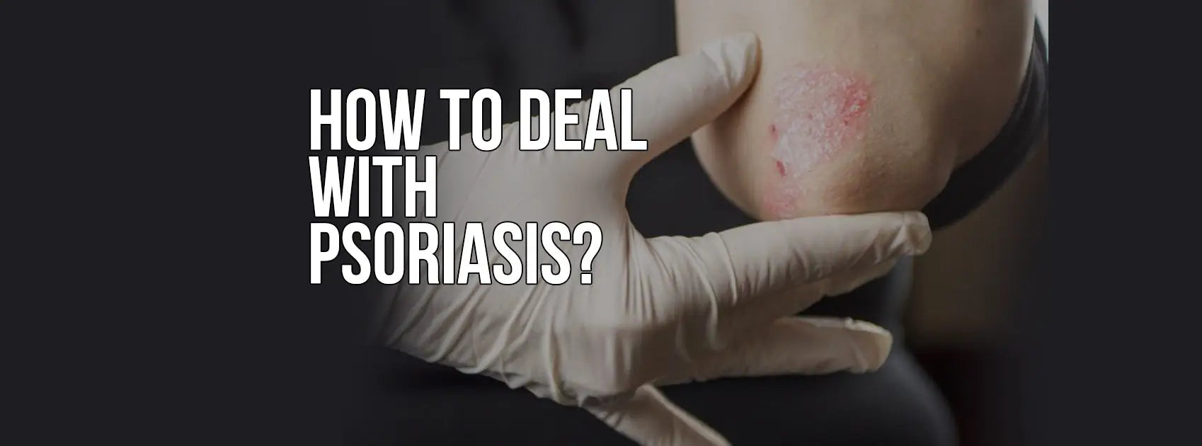 HOW TO DEAL WITH PSORIASIS & NATURAL REMEDIES