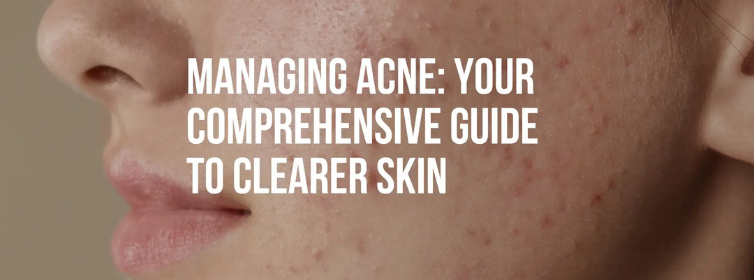 Managing Acne: Your Comprehensive Guide to Clearer Skin