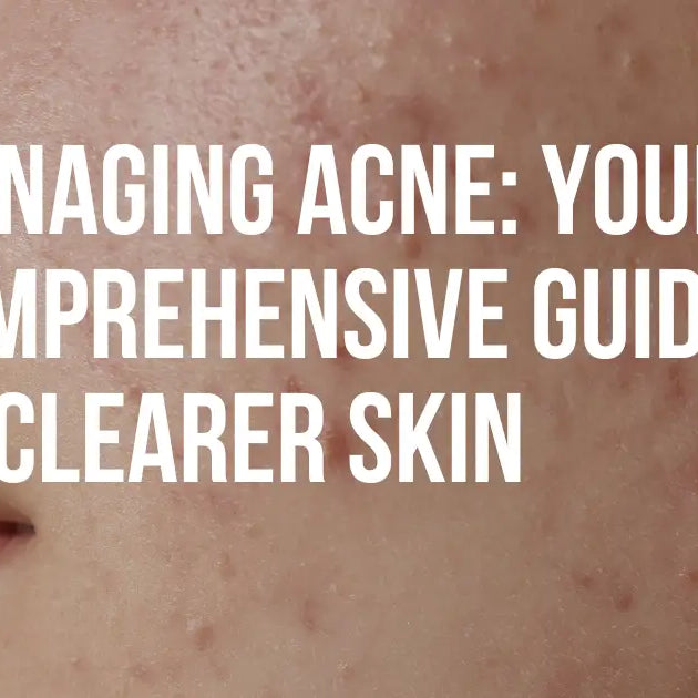 Managing Acne: Your Comprehensive Guide to Clearer Skin