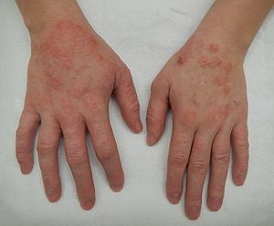 Allergic Skin Reactions & Rashes – The importance of Skin