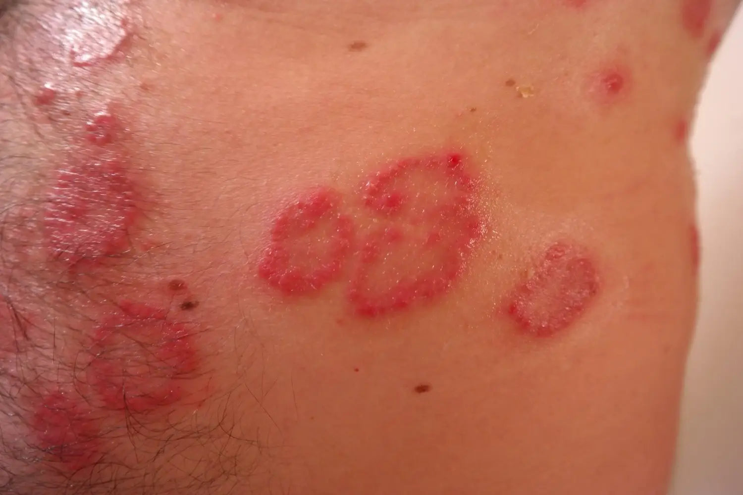 Plaque psoriasis