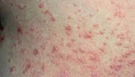 Guttate psoriasis