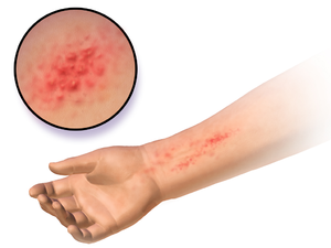 Allergic Skin Reactions & Rashes – The importance of Skin