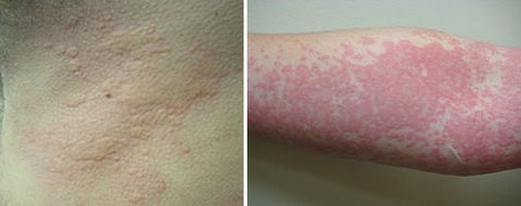 Allergic Skin Reactions & Rashes – The importance of Skin