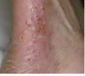 Pustular psoriasis