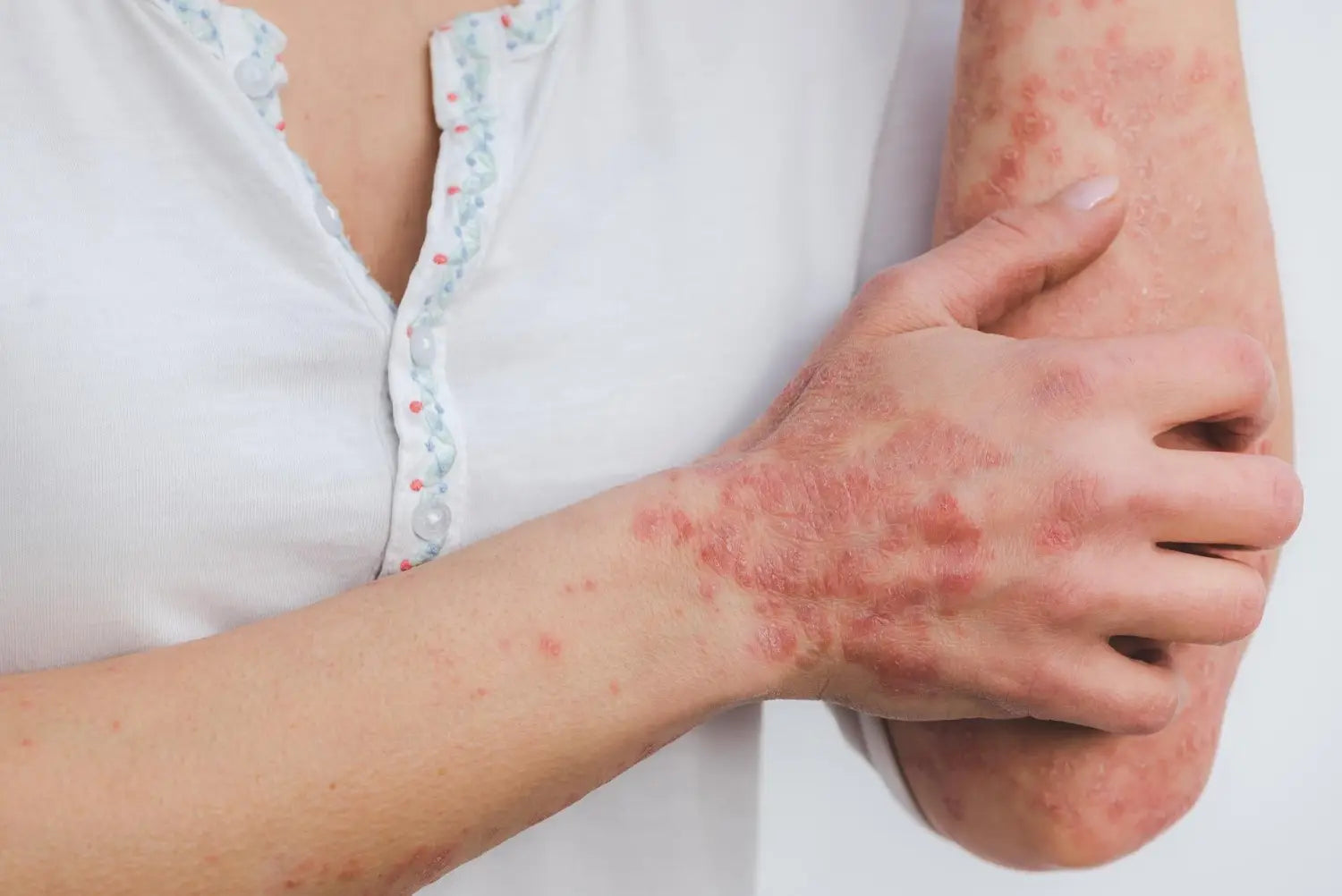 Woman with psoriasis on her arms and hands.