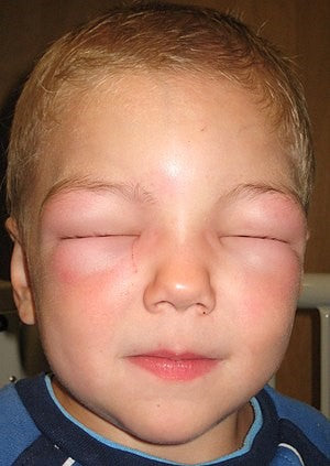 Allergic Skin Reactions & Rashes – The importance of Skin