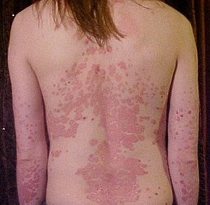 Allergic Skin Reactions & Rashes – The importance of Skin