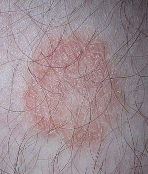 Allergic Skin Reactions & Rashes – The importance of Skin