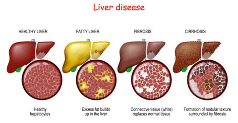 Liver disease