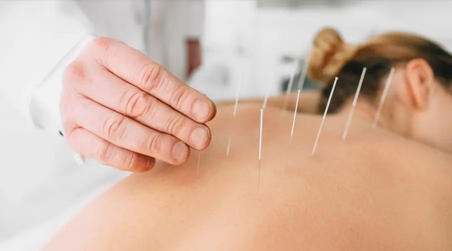 Woman having acupuncture treatment on her back