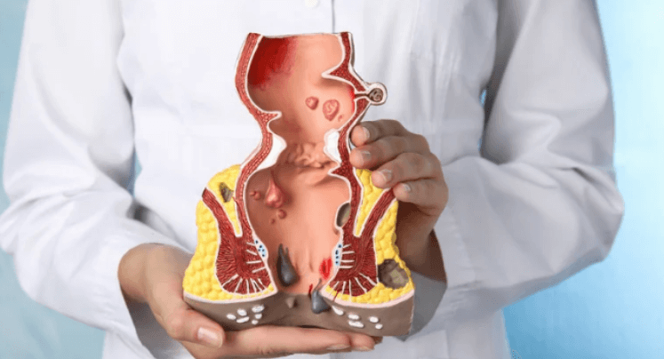 Doctor holding model of rectum