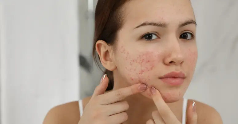 Woman looking at pimples on mirror