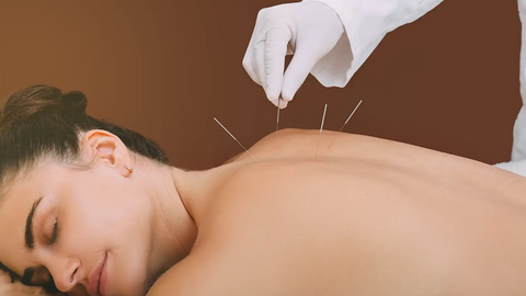 Woman on acupuncture appointment