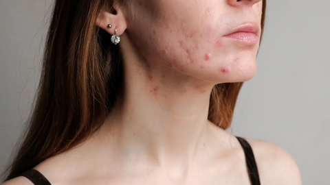 Woman with acne in her jaw