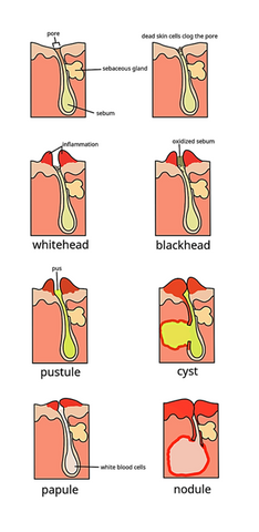 Illustration of different types of acne