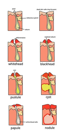 Illustration of different types of acne