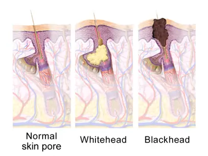 Illustration of a blackhead, a whitehead and a normal skin pore