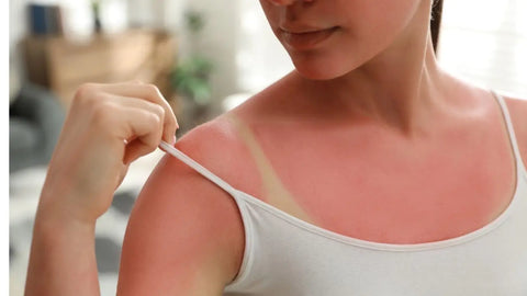 Woman with sunburn on her shoulders