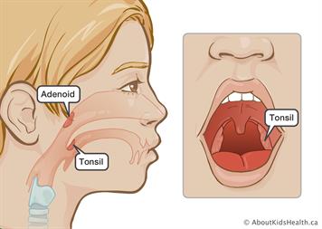 Graphic representation od adenoid and tonsil on human body