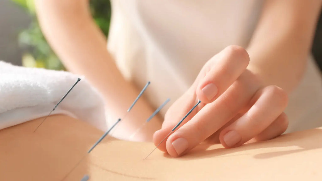 Acupuncture session
