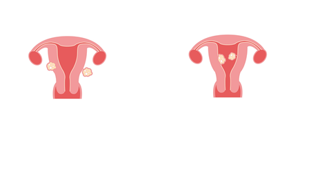 Fibroid Shrinkage and Irregular Menstrual Cycles