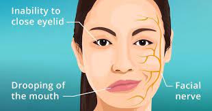 Graphic representation of facial paralysis