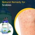 Scabies Treatment & Natural Remedy (BM211)