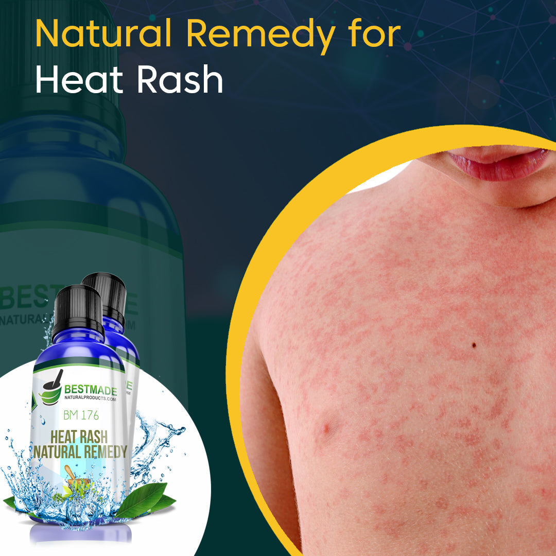 Natural Remedy for Heat Rash (BM176) 30ml - BM Products