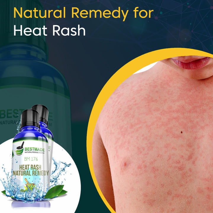 Natural Remedy for Heat Rash (BM176) 30ml - BM Products